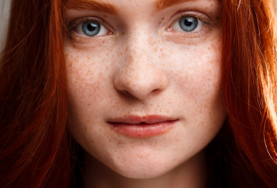 Freckles Treatment