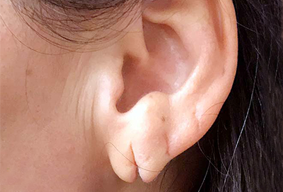 Ear Lobe Repair