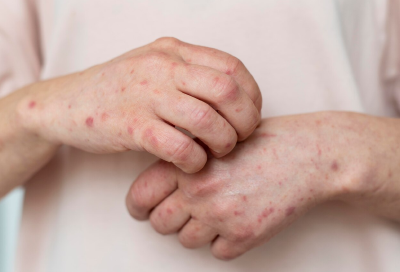 Skin Infections